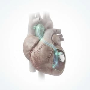 Heart Transplant (LVAD) Surgery